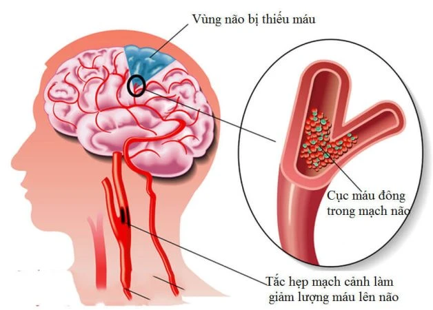 Đột quỵ thiếu máu cục bộ