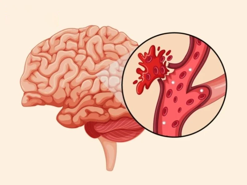 Đột quỵ xuất huyết não
